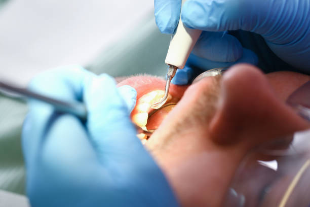 Best Emergency Root Canal Therapy in Delcambre, LA