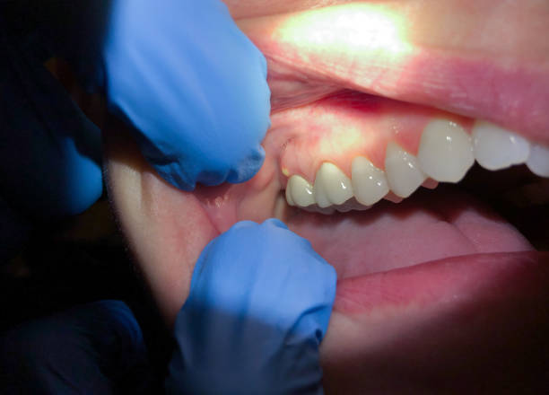 Best Knocked-Out Tooth (Avulsed Tooth) Treatment in Delcambre, LA