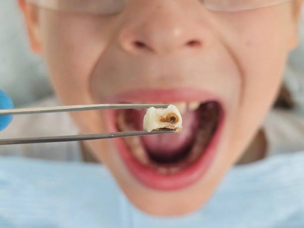 Best Broken or Chipped Tooth Repair in Delcambre, LA